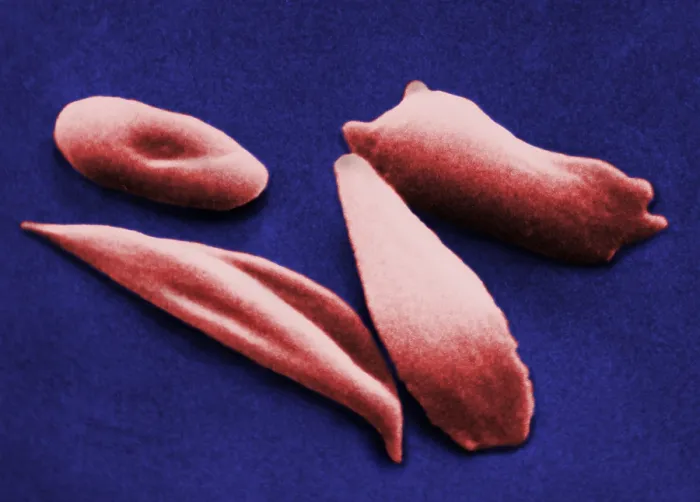 Framed Print : SCD, Sickle-Cell Anemia, under a microscope (SEM) Framed Print : SCD, Sickle-Cell Anemia, under a microscope (SEM)
