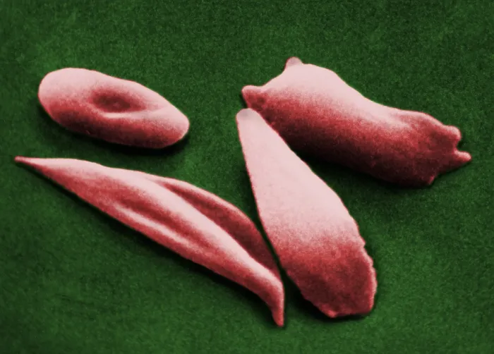 Framed Print : SCD, Sickle-Cell Anemia, under a microscope (SEM) Framed Print : SCD, Sickle-Cell Anemia, under a microscope (SEM)