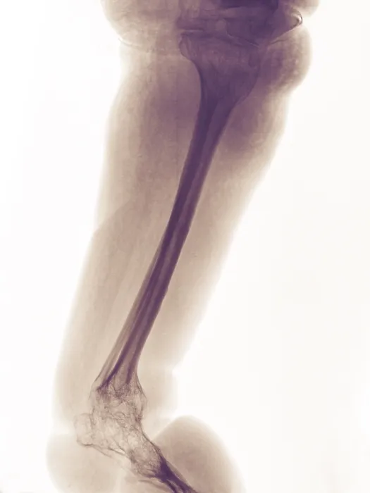 Framed Print : Severe Bone Degeneration in 63 Year Old Paraplegic Framed Print : Severe Bone Degeneration in 63 Year Old Paraplegic