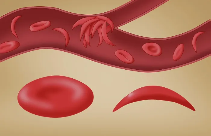 Framed Print : Sickle cell anemia disease, a normal blood cell, a sickle shaped blood cell, a clogged artery or blood vessel, illustration Framed Print : Sickle cell anemia disease, a normal blood cell, a sickle shaped blood cell, a clogged artery or blood vessel, illustration