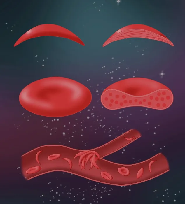 Framed Print : Sickle cell anemia disease, a normal blood cell, a sickle shaped blood cell, a clogged artery or blood vessel Framed Print : Sickle cell anemia disease, a normal blood cell, a sickle shaped blood cell, a clogged artery or blood vessel