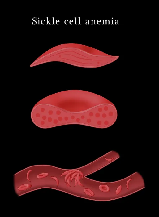 Framed Print : Sickle cell anemia disease, a normal blood cell, a sickle shaped blood cell, a clogged artery or blood vessel, illustration Framed Print : Sickle cell anemia disease, a normal blood cell, a sickle shaped blood cell, a clogged artery or blood vessel, illustration