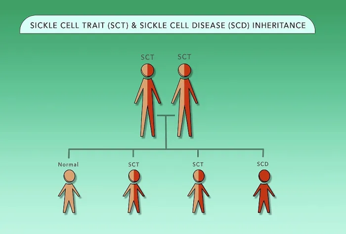 Framed Print : Sickle Cell Trait (SCT) and Sickle Cell Anemia Disease (SCD) genetic inheritance chart, medical illustration Framed Print : Sickle Cell Trait (SCT) and Sickle Cell Anemia Disease (SCD) genetic inheritance chart, medical illustration
