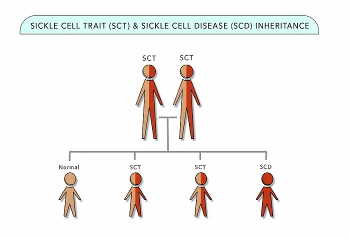 Framed Print : Sickle Cell Trait (SCT) and Sickle Cell Anemia Disease (SCD) genetic inheritance chart, medical illustration Framed Print : Sickle Cell Trait (SCT) and Sickle Cell Anemia Disease (SCD) genetic inheritance chart, medical illustration