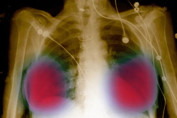 Framed Print : Silicone breast implants