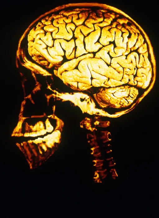 Framed Print : Skull With Brain Framed Print : Skull With Brain