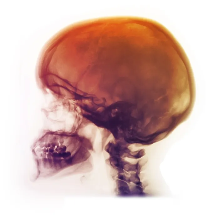 Framed Print : Skull of Healthy 42 Year Old Woman