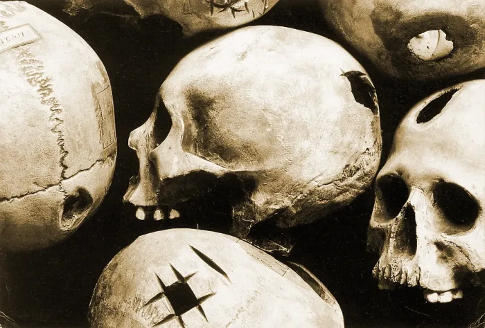 Framed Print : Skulls Showing Trepanation