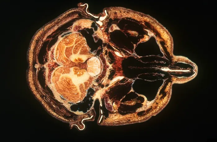 Framed Print : Slice of Human Brain, gross specimen
