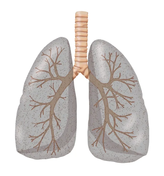 Framed Print : Smoker's Lungs Framed Print : Smoker's Lungs