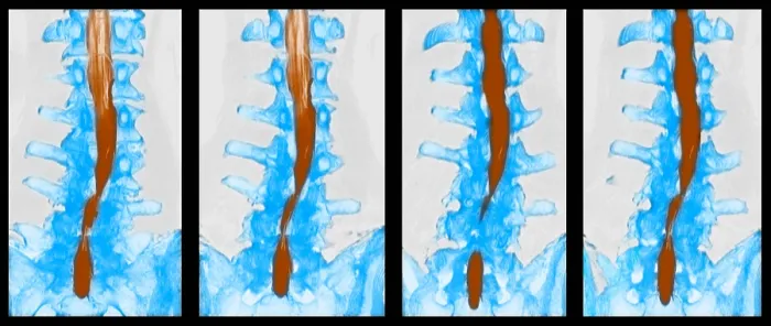 Framed Print : Spine, CT Scan Framed Print : Spine, CT Scan