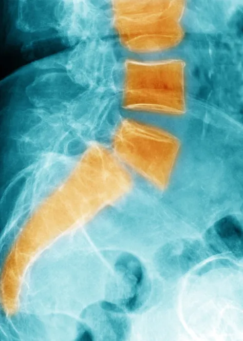 Framed Print : Spondylolisthesis Framed Print : Spondylolisthesis