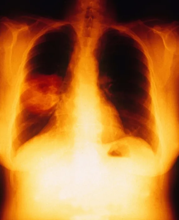Framed Print : Squamous Cell Carcinoma, Lungs, X-ray