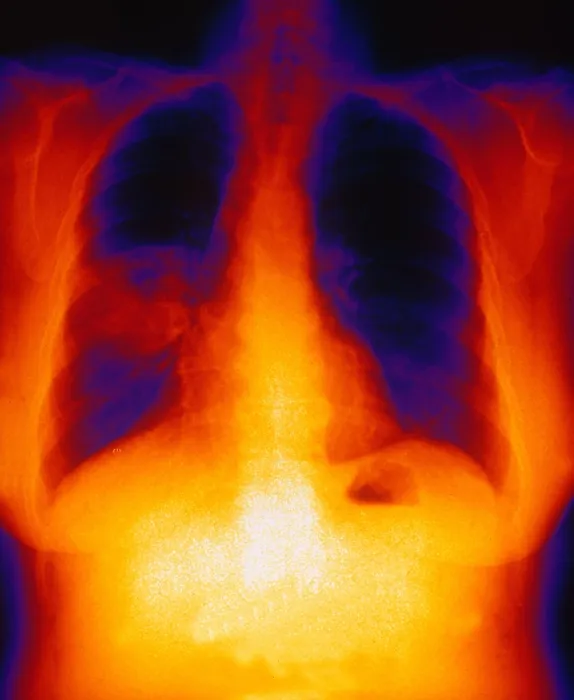 Framed Print : Squamous Cell Carcinoma, Lungs, X-ray Framed Print : Squamous Cell Carcinoma, Lungs, X-ray