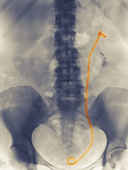 Framed Print : Stent from Kidney to Bladder Framed Print : Stent from Kidney to Bladder