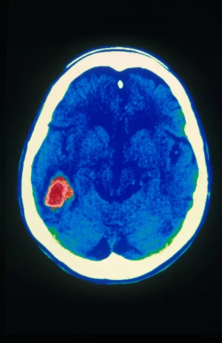 Framed Print : Stroke, CT Scan Framed Print : Stroke, CT Scan