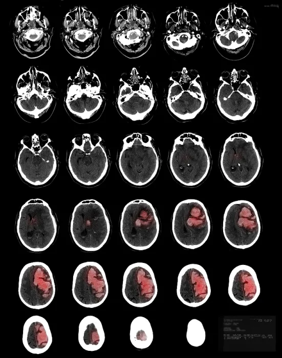 Framed Print : Stroke Montage, 82 year old man