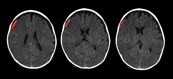 Framed Print : Subdural Hematoma in 6 Month Old, CT Scan