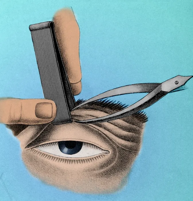Framed Print : Surgery to Correct Lazy Eyelid, 1830
