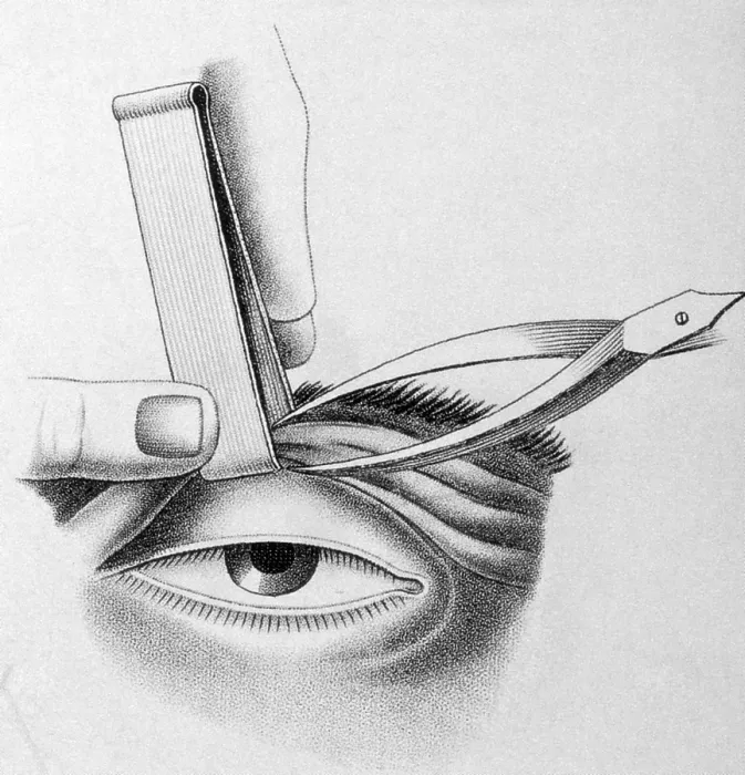 Framed Print : Surgery to Correct Lazy Eyelid, 1830 Framed Print : Surgery to Correct Lazy Eyelid, 1830