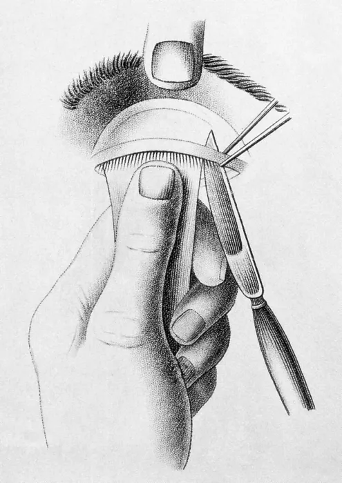 Framed Print : Surgery to Correct Lazy Upper Eyelid, c, 1830 Framed Print : Surgery to Correct Lazy Upper Eyelid, c, 1830