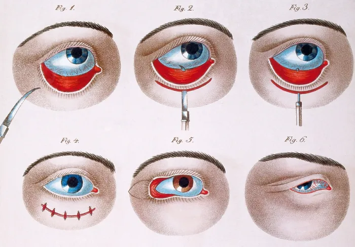Framed Print : Surgery to Correct Ptosis, 1830 Framed Print : Surgery to Correct Ptosis, 1830