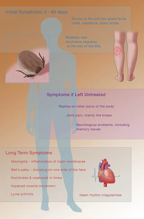 Framed Print : Symptoms of Lyme Disease, Illustration