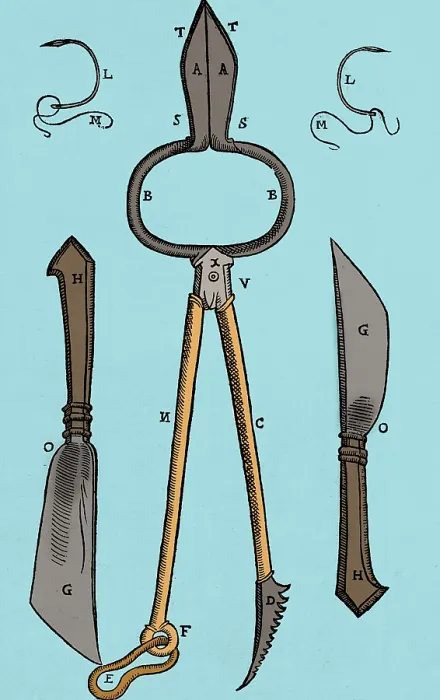 Framed Print : Tagliacozzi Rhinoplasty Method Equipment