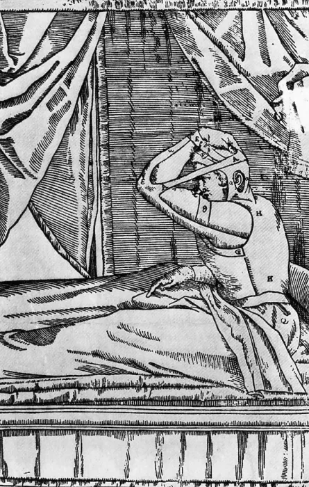 Framed Print : Tagliacozzi's Method of Growing New Nose from Arm Skin Framed Print : Tagliacozzi's Method of Growing New Nose from Arm Skin