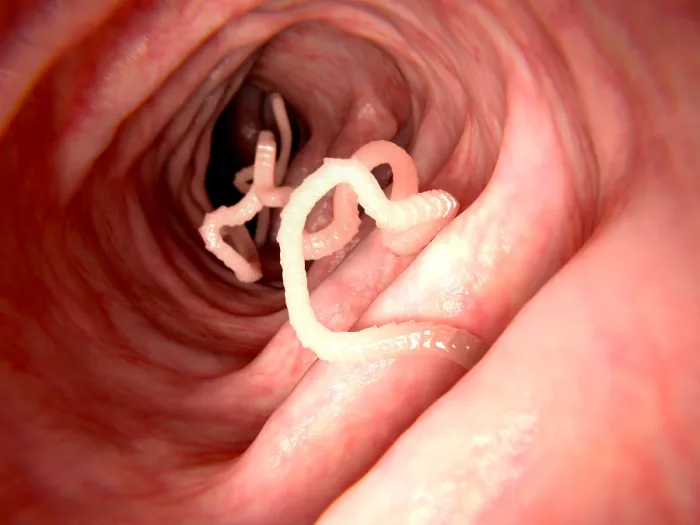 Framed Print : Tapeworm in human intestine Framed Print : Tapeworm in human intestine