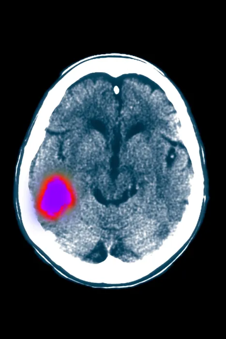 Framed Print : Temporal lobe stroke