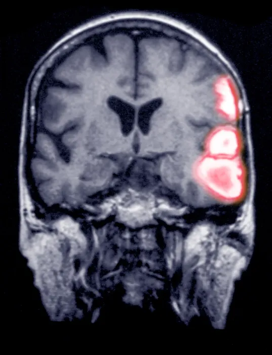 Framed Print : Temporoparietal brain hemorrhage, MRI Framed Print : Temporoparietal brain hemorrhage, MRI