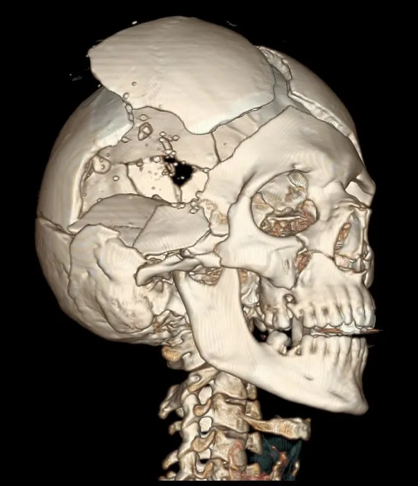 Framed Print : Three-Dimensional CT Reconstruction, Skull with Bullet Wounds Framed Print : Three-Dimensional CT Reconstruction, Skull with Bullet Wounds