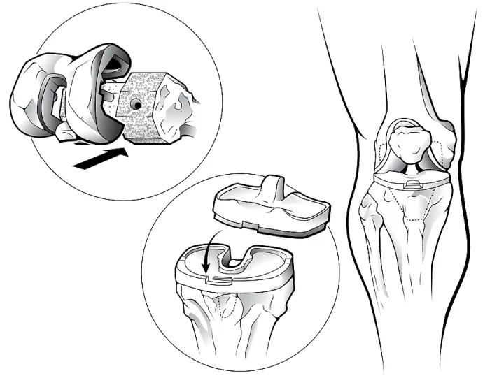 Framed Print : Total Knee Replacement (Prosthetic) Framed Print : Total Knee Replacement (Prosthetic)