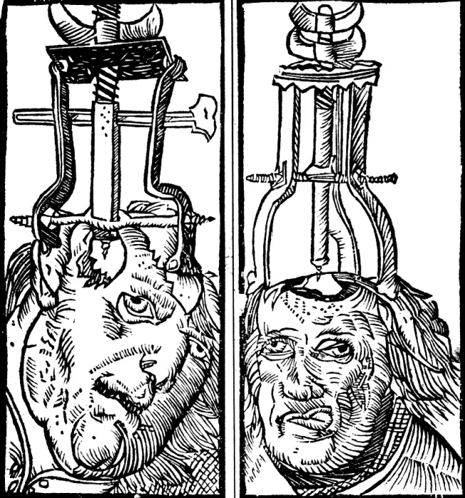Framed Print : Trepanning, 1525 Framed Print : Trepanning, 1525