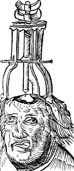 Framed Print : Trepanning, 1525 Framed Print : Trepanning, 1525