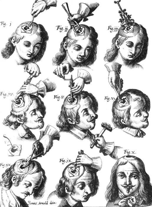 Framed Print : Trepanning, 1666 Framed Print : Trepanning, 1666