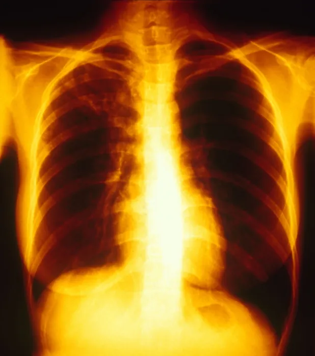 Framed Print : Tuberculosis, X-ray Framed Print : Tuberculosis, X-ray