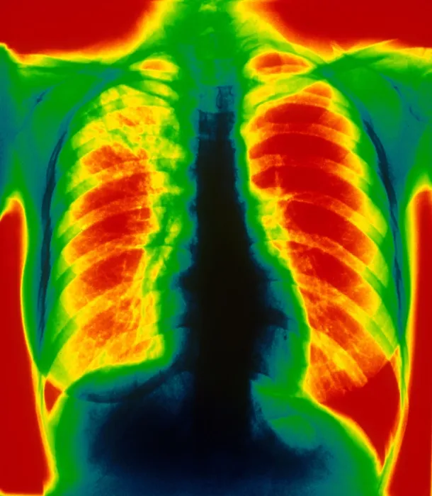 Framed Print : Tuberculosis, X-ray Framed Print : Tuberculosis, X-ray