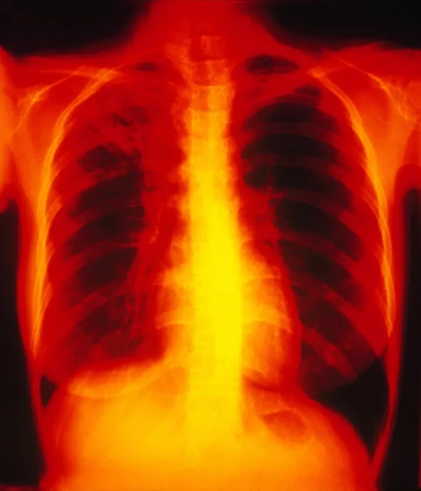 Framed Print : Tuberculosis, X-ray Framed Print : Tuberculosis, X-ray