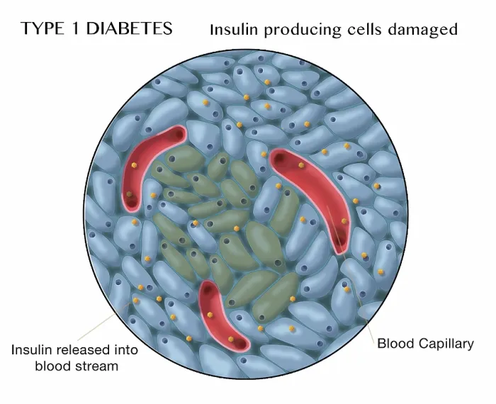Framed Print : Type 1 Diabetes, Damaged Islets of Langerhans Cells Framed Print : Type 1 Diabetes, Damaged Islets of Langerhans Cells