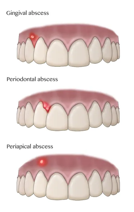 Framed Print : Types of Dental Abscesses, Illustration