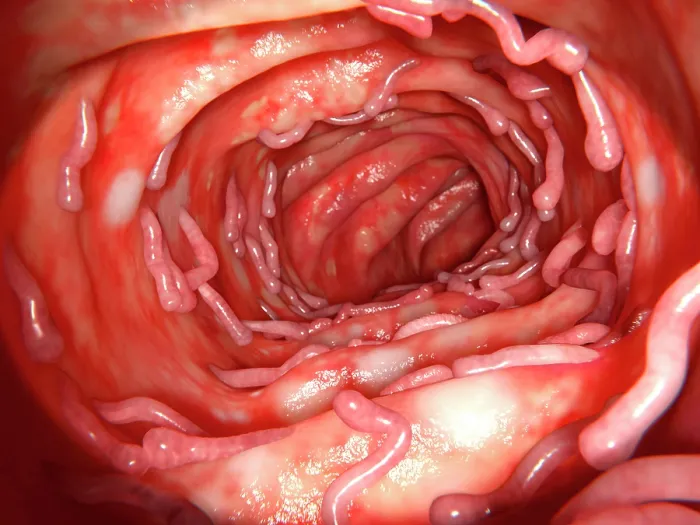 Framed Print : Ulcerative colitis and pseudopolyps, illustration Framed Print : Ulcerative colitis and pseudopolyps, illustration