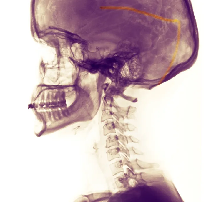 Framed Print : Ventricular Shunt for the Treatment of Hydrocephalus Framed Print : Ventricular Shunt for the Treatment of Hydrocephalus