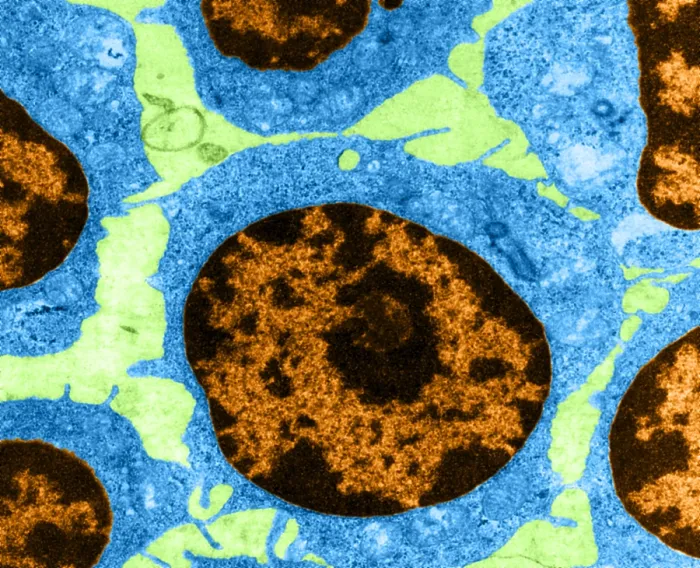 Framed Print : White Blood Cells in Leukemia (TEM) Framed Print : White Blood Cells in Leukemia (TEM)