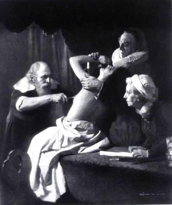 Framed Print : Wilhelm Fabry, German Surgeon Framed Print : Wilhelm Fabry, German Surgeon
