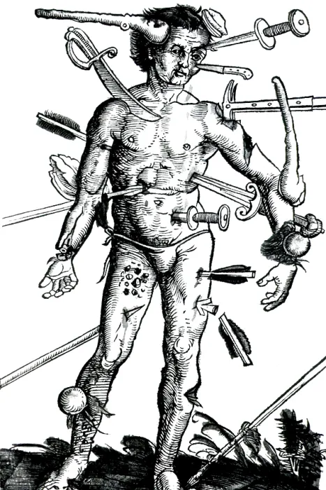 Framed Print : Wound Man, 'Feldbuch der Wundartzney' 1517 Framed Print : Wound Man, 'Feldbuch der Wundartzney' 1517