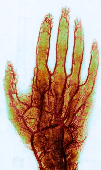 Framed Print : X-ray of Blood Vessels