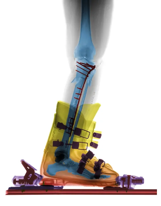 Framed Print : X-ray of Broken Bones in Ski boot Framed Print : X-ray of Broken Bones in Ski boot