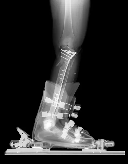 Framed Print : X-ray of Broken Bones in Ski boot